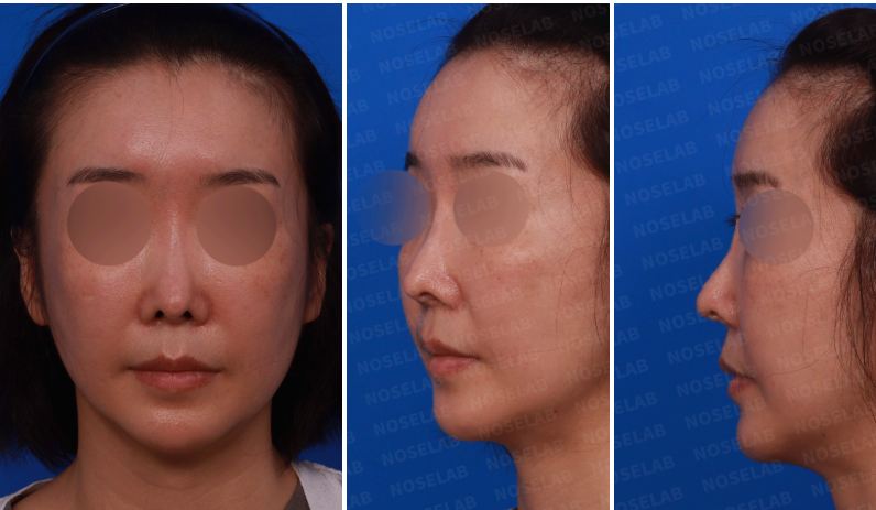 Preoperative design consultation photos for complex revision rhinoplasty – frontal, left oblique side, and left side views of female patient