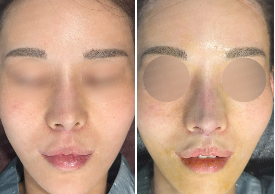 Frontal view before and immediately after deviated nose correction, showing improved nasal alignment and reduced asymmetry.