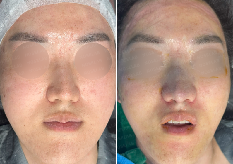 Frontal view comparison before and immediately after implant-free closed rhinoplasty in a male patient