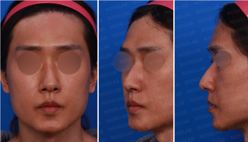 Frontal, left side, and oblique side views before closed 3D-printed dorsal augmentation in Korea.