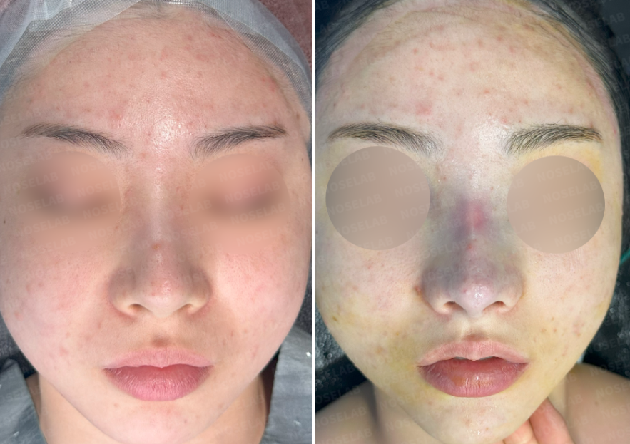 Before and immediately after surgery comparison photos of a female patient, frontal view, showing bulbous nose correction after filler and thread lift with closed rhinoplasty.
