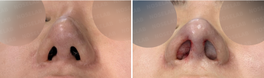 Before and immediately after revision rhinoplasty for nasal contracture – nostril view showing improved symmetry and internal structure.