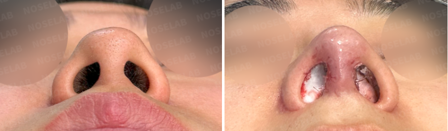 Before and immediately after Short and Low Nasal Bridge Rhinoplasty: basal nostril view showing corrected columella position, reduced nostril width, and improved symmetry.