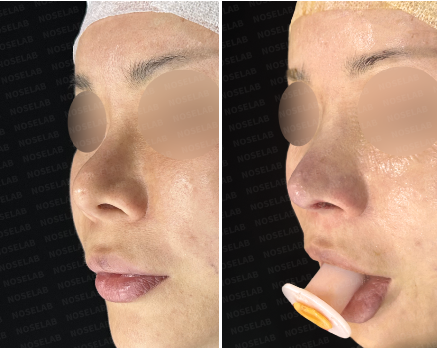 Before and immediately after surgery oblique view showing correction of upturned nasal tip, improved alar contour, and reduced nostril show following revision closed rhinoplasty with rib cartilage reconstruction.