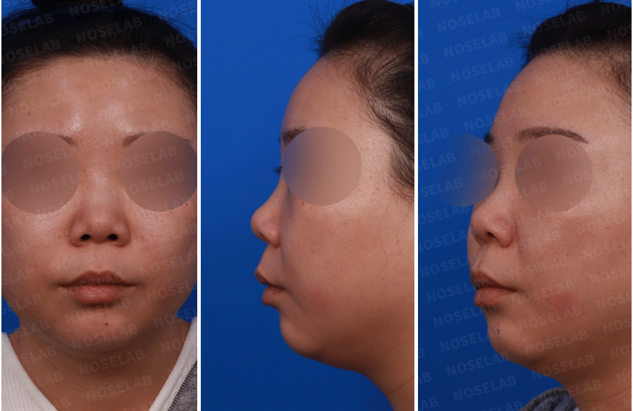 Short Nose Correction – Preoperative frontal, side, and oblique view photos showing a small, upturned nose with wide nasal base and short columella before closed rhinoplasty.