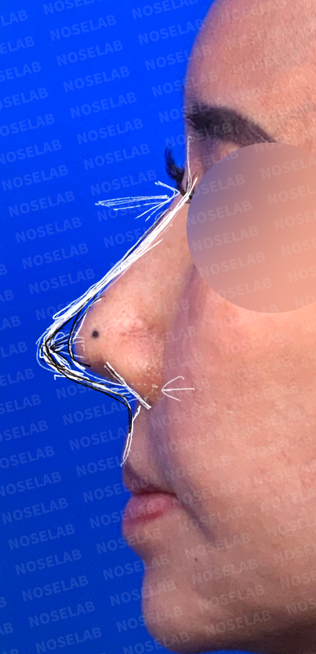Detailed lateral view assessment of nasal structure showing tip projection and columellar position during preoperative rhinoplasty consultation in Seoul