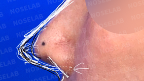 Preoperative side view showing nasal deviation and upturned tip before Closed Rhinoplasty Korea – surgical design indicating correction of retracted columella and asymmetric nostrils using self-rib cartilage.