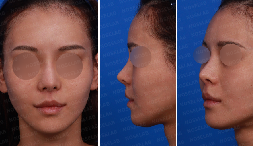 Pre-surgery design consultation photos for deviated nose correction: frontal, oblique, and side views