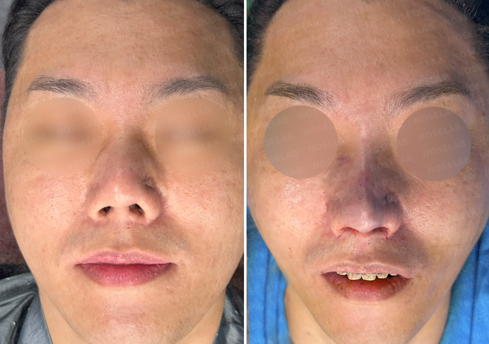 Before and after frontal view of nasal contracture reconstruction with rib cartilage graft and closed rhinoplasty