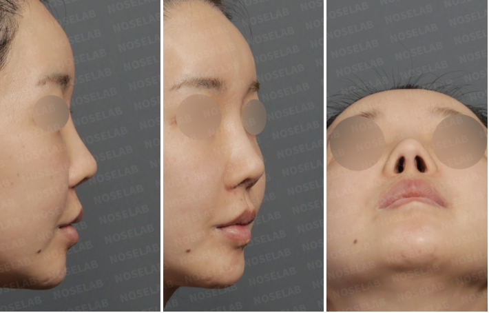 Preoperative right side, right oblique, and nostril views showing short upturned nose deformity.