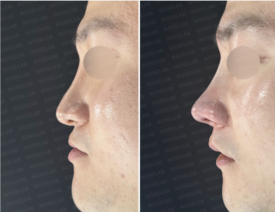 Left lateral view comparison showing preoperative nasal profile on the left and immediate postoperative appearance on the right after septal deviation correction and structural nasal reconstruction.