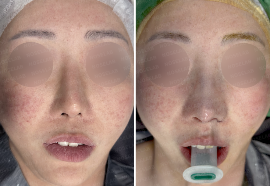 Before and immediately after surgery frontal view comparison showing improved nasal symmetry and midline alignment following septal reconstruction in revision rhinoplasty.