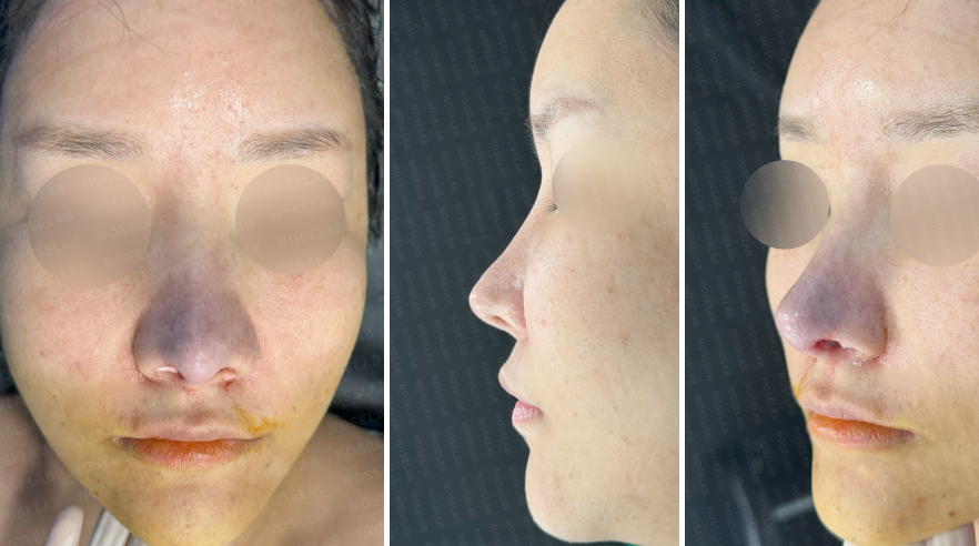 Immediately after autologous rib cartilage revision rhinoplasty in Korea – frontal, side, and oblique side views showing straightened nose, lowered bridge starting point, and refined nasal tip projection.