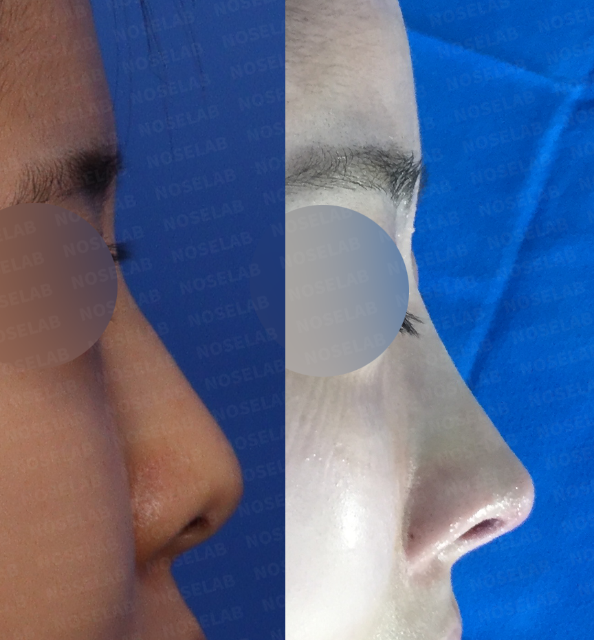 Side profile comparison showing nasal bridge refinement and tip repositioning in thin-skinned rhinoplasty patient at Seoul clinic
