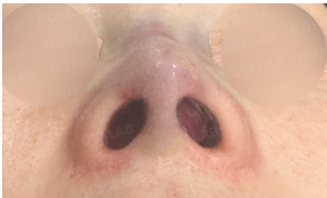 Postoperative nostril view showing symmetrical nasal base and improved columella alignment after rib cartilage rhinoplasty