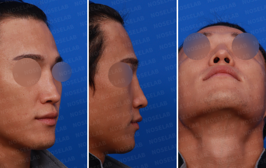 Preoperative design consultation photos of a male patient: right oblique side view, side view, and nostril view for crooked nose and nasal bridge evaluation.