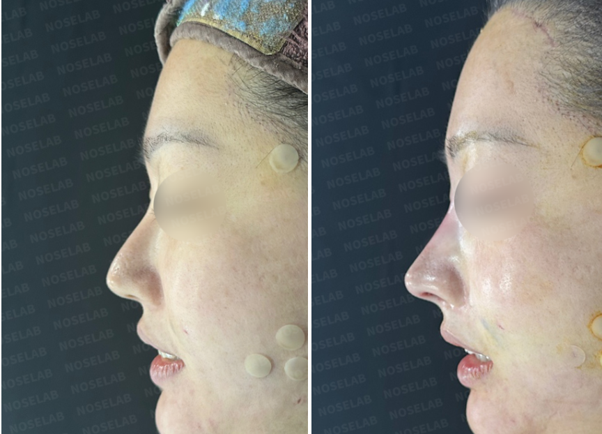 Side profile comparison before and immediately after revision rhinoplasty using rib cartilage to correct a deviated and drooping nose.