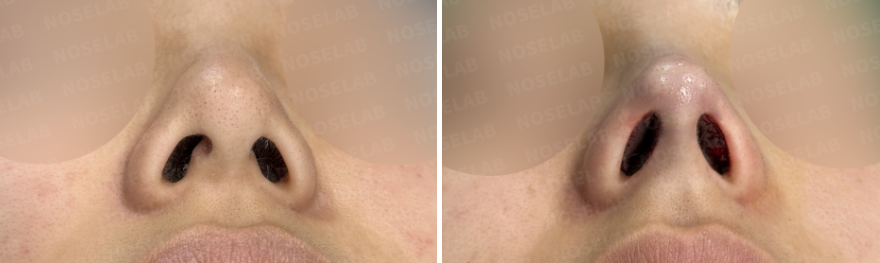 Crooked hump nose correction Korea nostril view before and after showing septal alignment