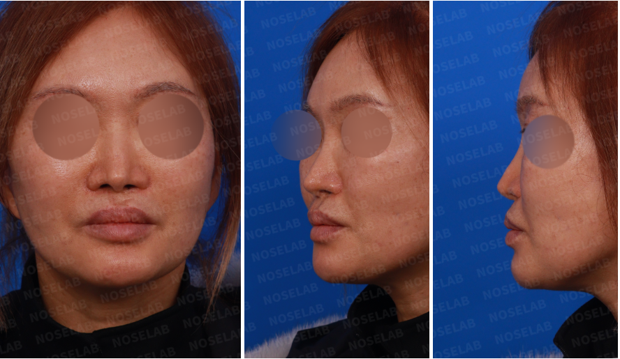 Preoperative design consultation photos for cleft lip nose revision surgery – frontal, left profile, and oblique side view of the patient before undergoing secondary rhinoplasty at Nose Lab Clinic