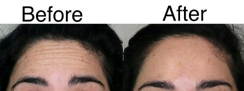 forehead lines 3_edited.jpg