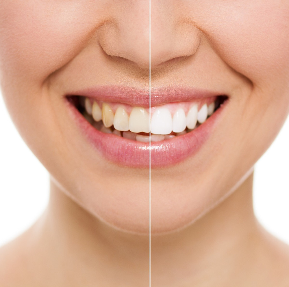Before and After