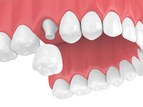 process for dental crown placement