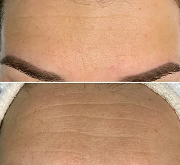 Unleashing the Power of Fibroblast Cells: Your Skin’s Secret Weapon