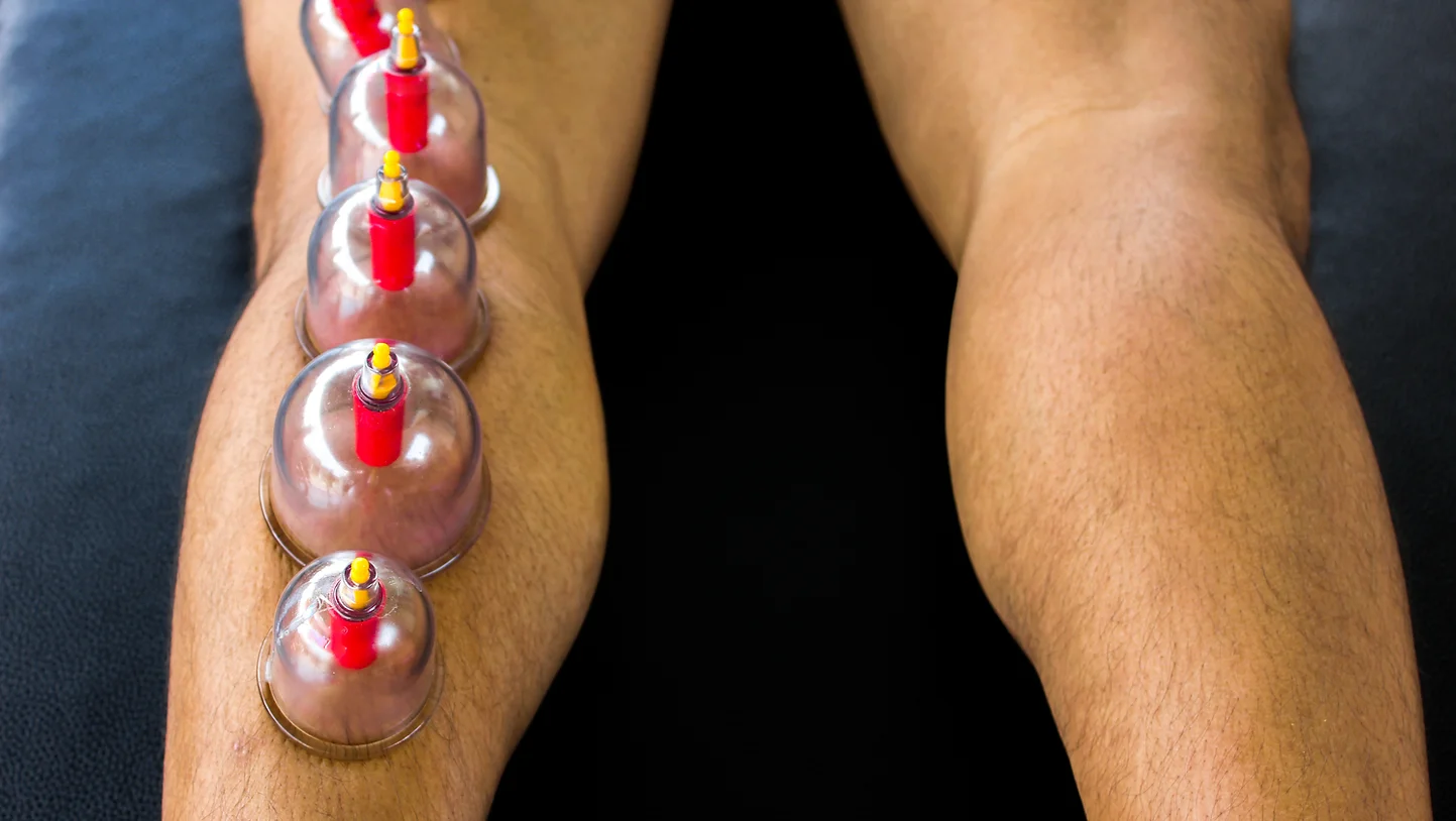 lower extremity cupping.webp
