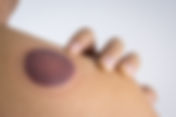 (Live OnLine) Introduction to Cupping Therapy