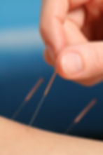 Community Acupuncture 