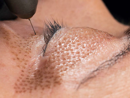 WHAT IS THE PLASMA FIBROBLAST SKIN TIGHTENING TREATMENT?