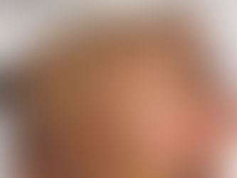 What is Dermaplaning