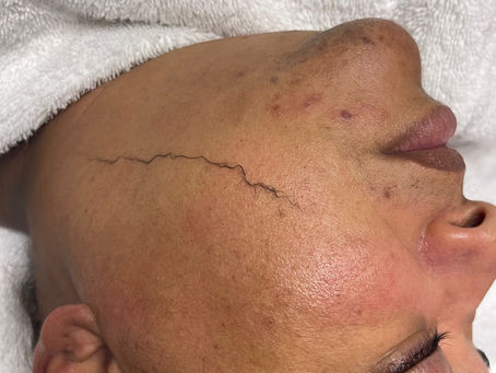 What is Dermaplaning