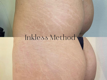 Inkless stretch marks reduction