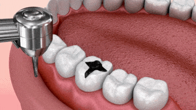 Gif fillings short 1.1.gif