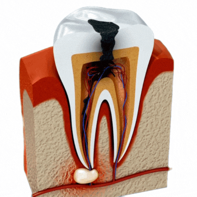 root canal no fondo x2.gif