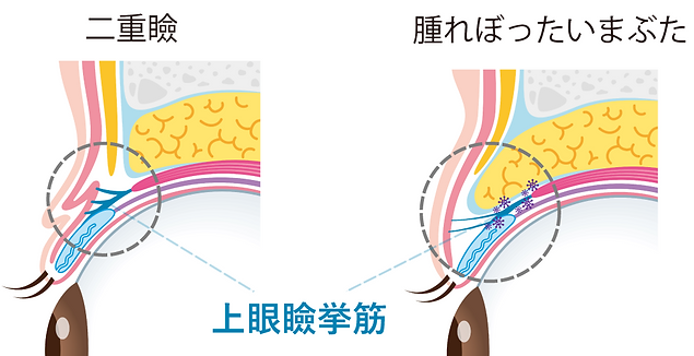 上眼瞼挙筋 一重 二重 教育資料.png