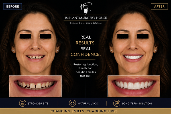 fullmouthimplant.png