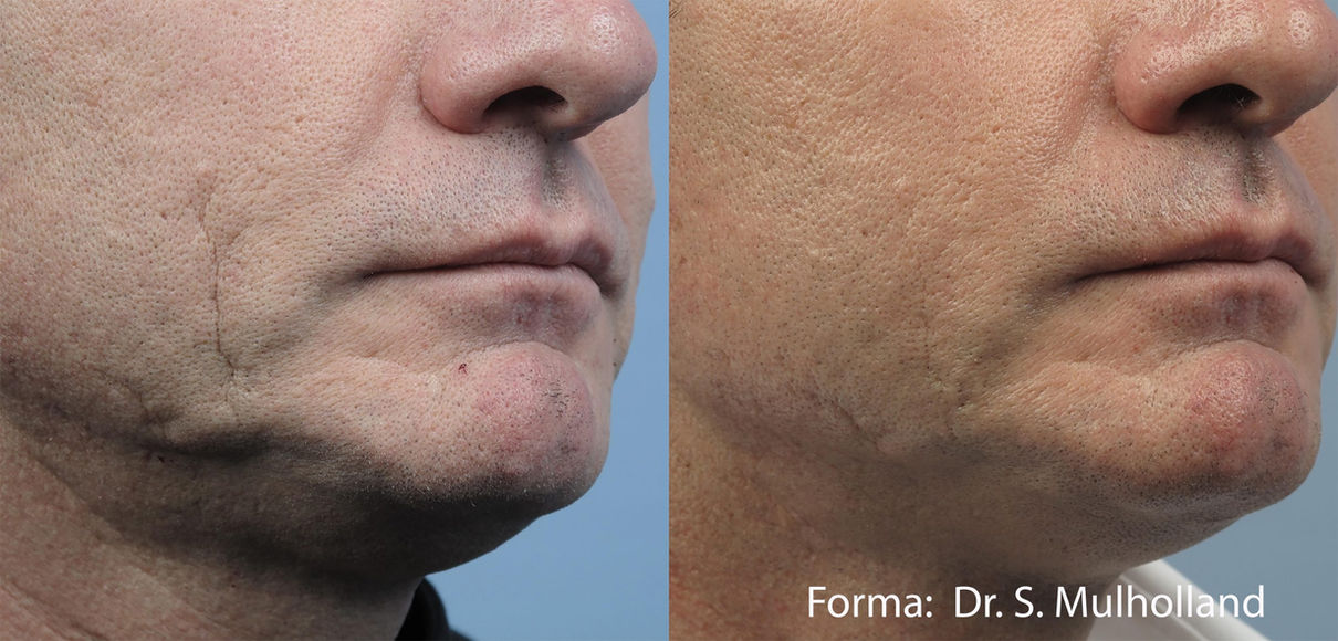 Before and after image of a male client after Forma Treatment