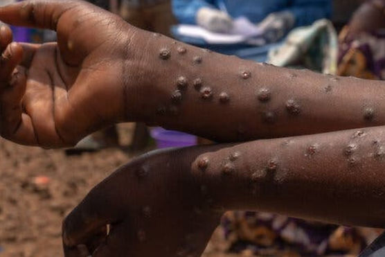 Mpox.jpg