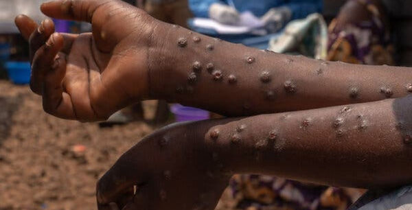 Mpox.jpg