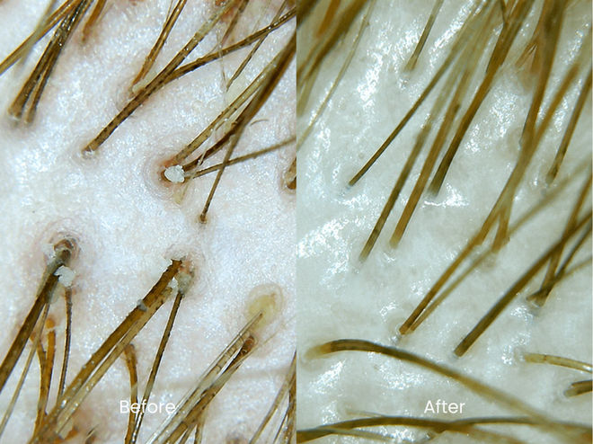 Microscope before and after results of a therapeutic scalp facial in Huntsville TX.