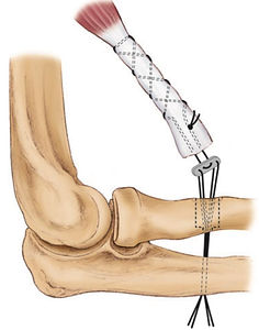 distal biceps repair.jpg