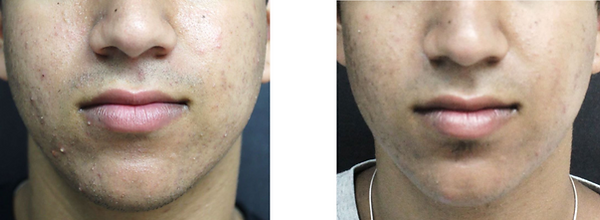 V-IPL Acne.png