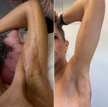 Scar camouflage Scar Revision Scar tattoo Jacksonville, North Carolina