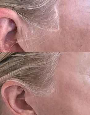 Scar camouflage Scar Revision Scar tattoo Jacksonville, North Carolina