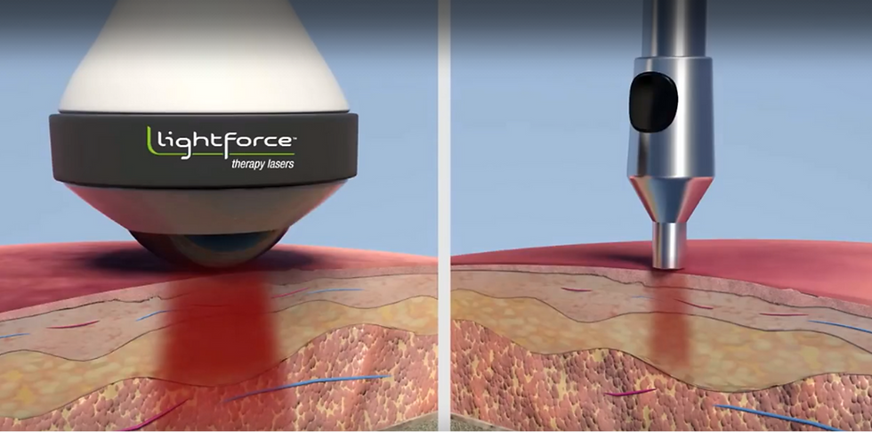 Deep Tissue Laser Therapy - Comprehensive Chiropractic - Eureka, MO