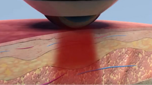 Eureka Residents Get Faster Pain Relief with this New Therapy! 