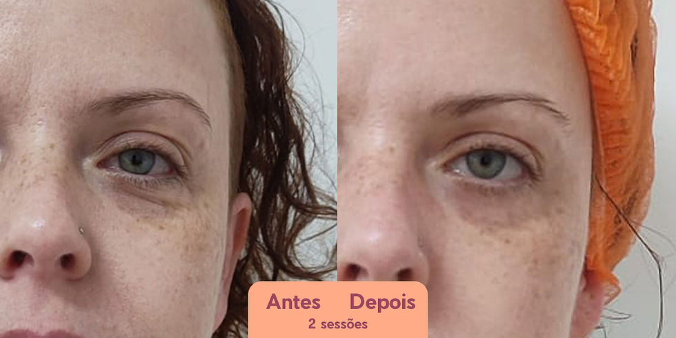 lineless-antes-depois-bioestimulador-colageno