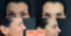 botox